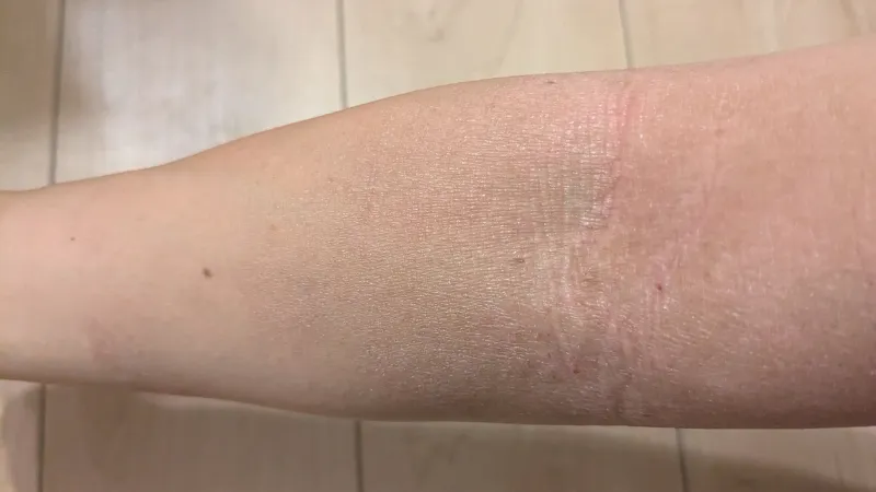 乾燥肌アンケート1